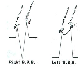 In RBBB the right ventricle